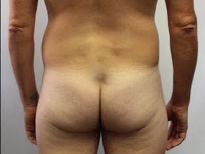 Brazilian Butt Lift for Men  Before & After Gallery - Patient 148128770 - Image 1