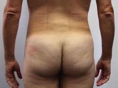 Brazilian Butt Lift for Men  Before & After Gallery - Patient 148128770 - Image 2