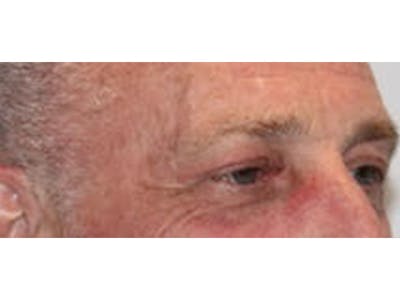Eyelid Surgery Before & After Gallery - Patient 100688 - Image 2
