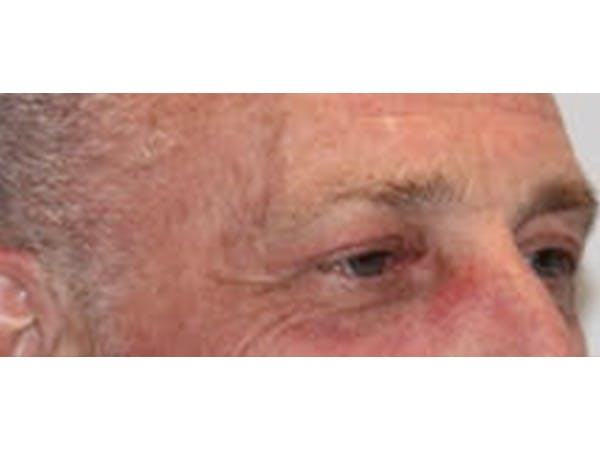 Eyelid Surgery Before & After Gallery - Patient 100688 - Image 2