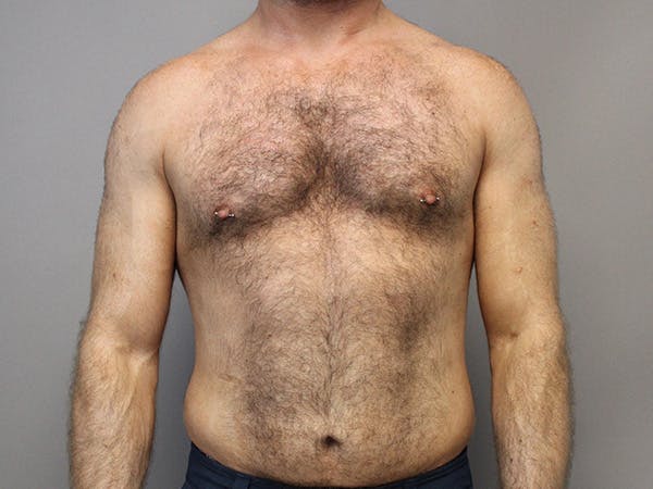 Liposuction Before & After Gallery - Patient 777657 - Image 1