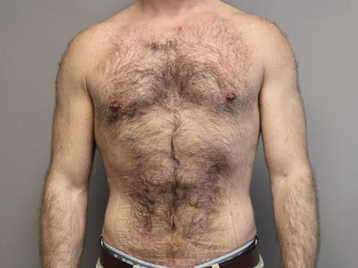 Liposuction Before & After Gallery - Patient 777657 - Image 2