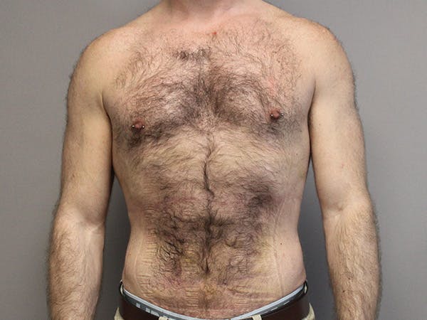 Liposuction For Men Before & After Gallery - Patient 331520 - Image 2