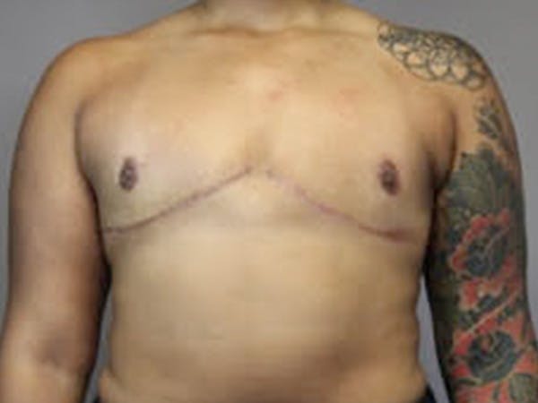 Female to Male Before & After Gallery - Patient 248628 - Image 2