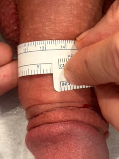 Penis Enlargement Before & After Gallery - Patient 205521 - Image 2