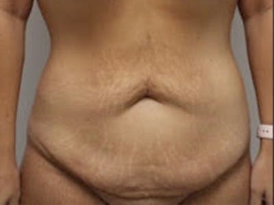 Tummy Tuck Before & After Gallery - Patient 232049 - Image 1