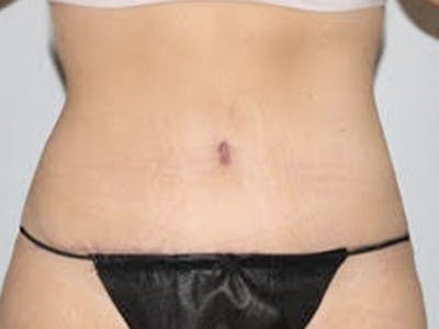 Tummy Tuck Before & After Gallery - Patient 232049 - Image 2