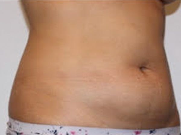 Liposuction Before & After Gallery - Patient 215804 - Image 1