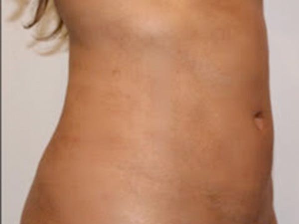 Liposuction Before & After Gallery - Patient 215804 - Image 2