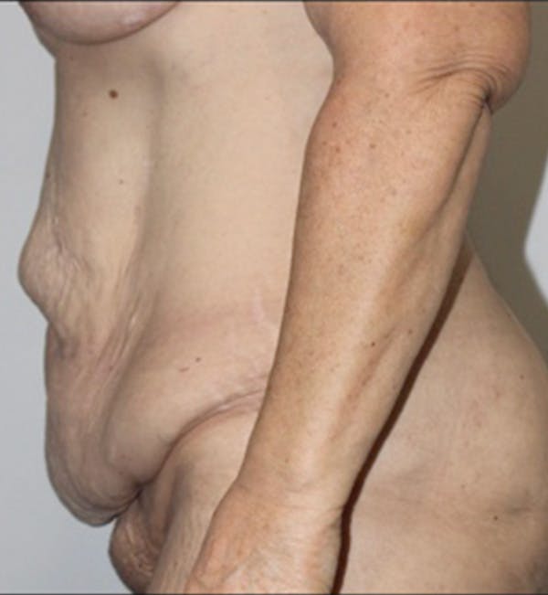 Renuvion Body Before & After Gallery - Patient 117648 - Image 1