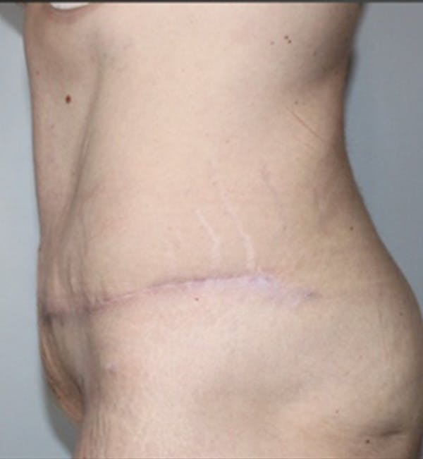 Renuvion Body Before & After Gallery - Patient 117648 - Image 2