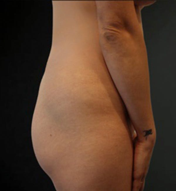 Liposuction Before & After Gallery - Patient 408594 - Image 1