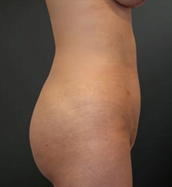 Liposuction Before & After Gallery - Patient 408594 - Image 2