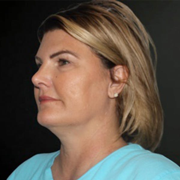 Facelift Before & After Gallery - Patient 180792 - Image 1