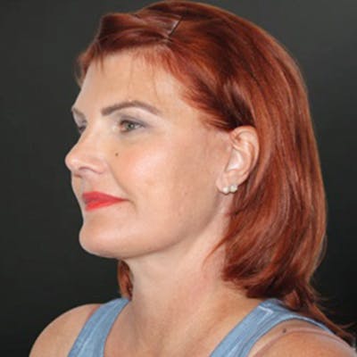 Facelift Before & After Gallery - Patient 180792 - Image 2