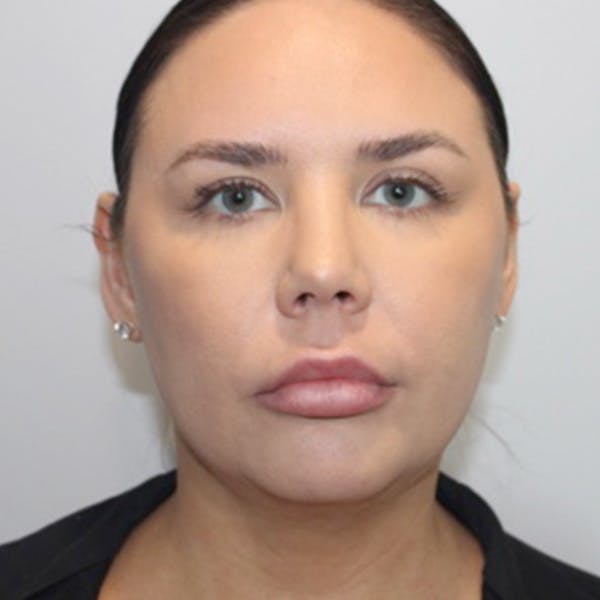 Liposuction of Neck & Jaw with Renuvion Before & After Gallery - Patient 162616 - Image 3