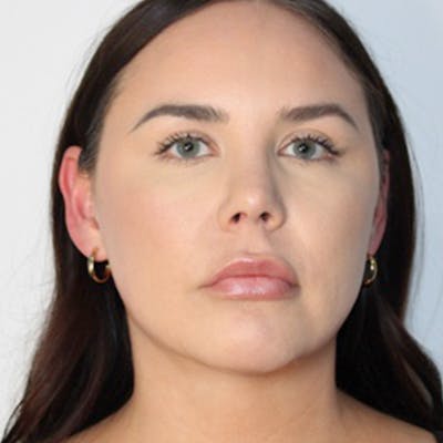 Liposuction of Neck & Jaw with Renuvion Before & After Gallery - Patient 162616 - Image 4