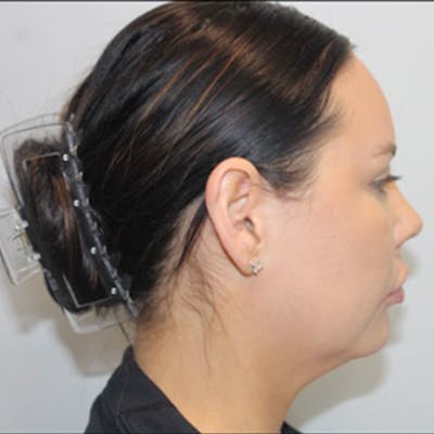 Liposuction of Neck & Jaw with Renuvion Before & After Gallery - Patient 162616 - Image 1