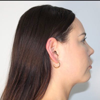 Liposuction of Neck & Jaw with Renuvion Before & After Gallery - Patient 162616 - Image 2
