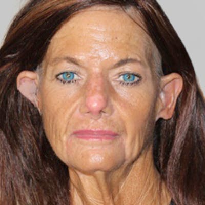 Croton Oil Peel Before & After Gallery - Patient 401507 - Image 1