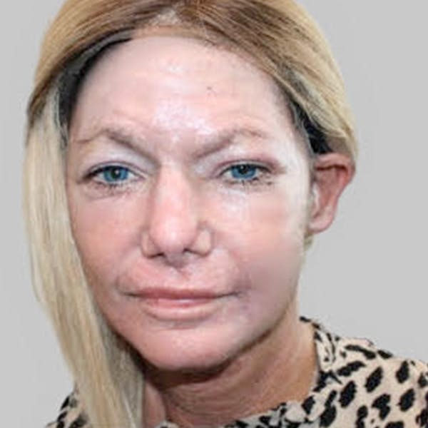Facelift Before & After Gallery - Patient 177135 - Image 2