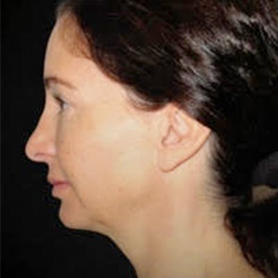 Fat Grafting Before & After Gallery - Patient 242122 - Image 1