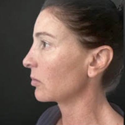 Fat Grafting Before & After Gallery - Patient 242122 - Image 2