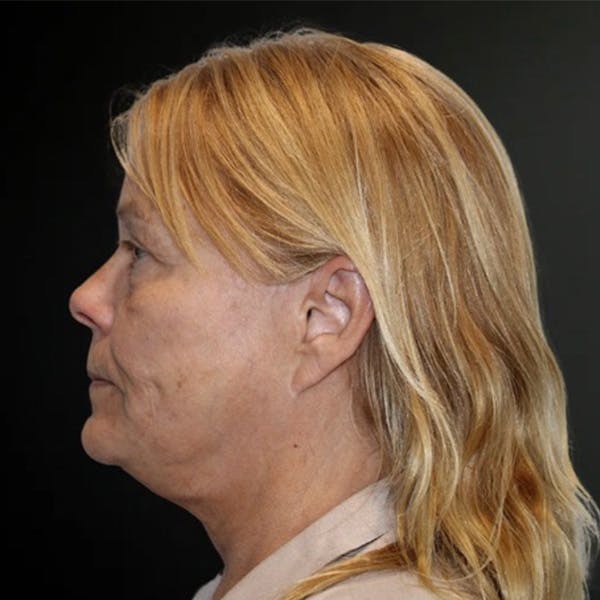 Facelift Before & After Gallery - Patient 150238 - Image 1