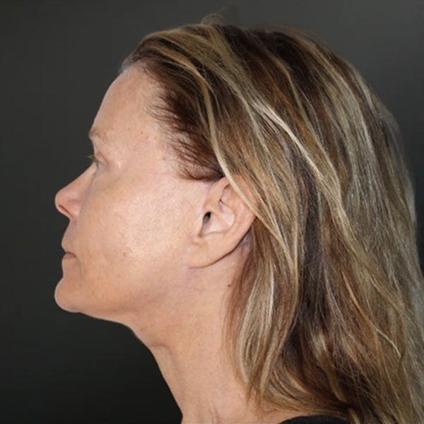 Facelift Before & After Gallery - Patient 150238 - Image 2
