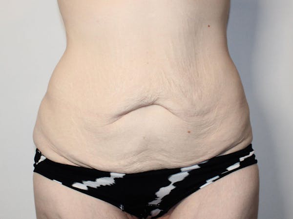Tummy Tuck Before & After Gallery - Patient 167181 - Image 1