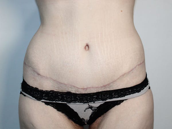 Tummy Tuck Before & After Gallery - Patient 167181 - Image 2
