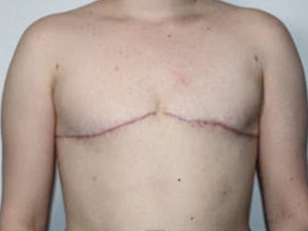 Female to Male Before & After Gallery - Patient 397051 - Image 2