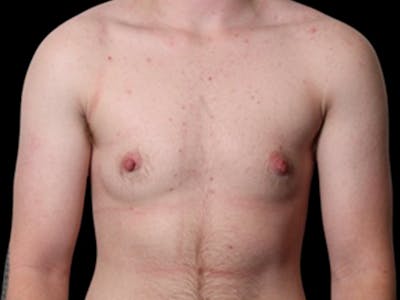 Female to Male Before & After Gallery - Patient 545805 - Image 1