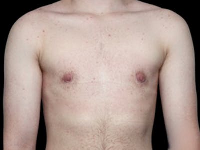 Female to Male Before & After Gallery - Patient 545805 - Image 2