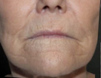 Croton Oil Peel Before & After Gallery - Patient 341136 - Image 1