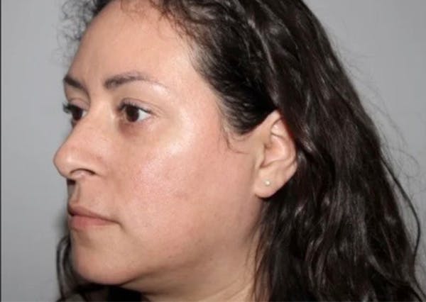 Dermal Fillers Before & After Gallery - Patient 653197 - Image 1
