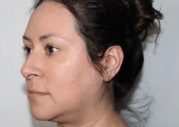 Dermal Fillers Before & After Gallery - Patient 653197 - Image 2