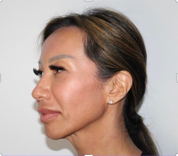 Dermal Fillers Before & After Gallery - Patient 213202 - Image 2