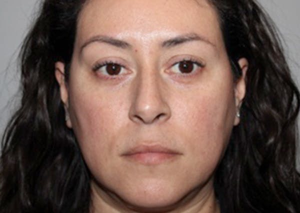 Dermal Fillers Before & After Gallery - Patient 653197 - Image 3
