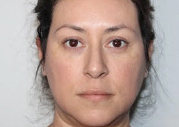 Dermal Fillers Before & After Gallery - Patient 653197 - Image 4