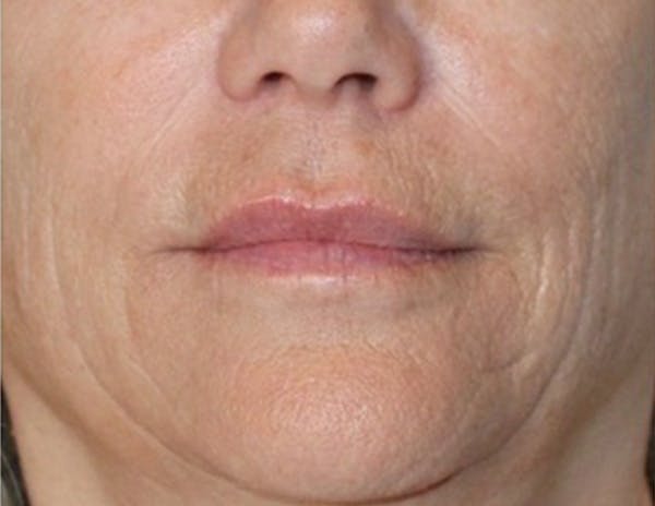 Croton Oil Peel Before & After Gallery - Patient 104988 - Image 1