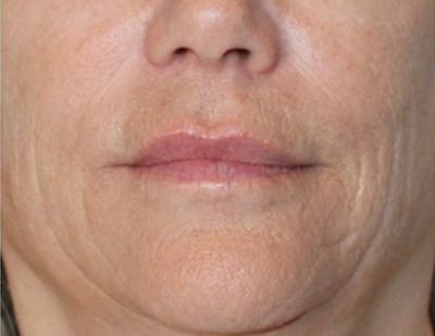 Croton Oil Peel Before & After Gallery - Patient 104988 - Image 1