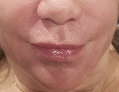 Croton Oil Peel Before & After Gallery - Patient 104988 - Image 2
