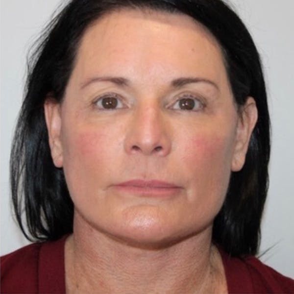 Facelift Before & After Gallery - Patient 352015 - Image 2