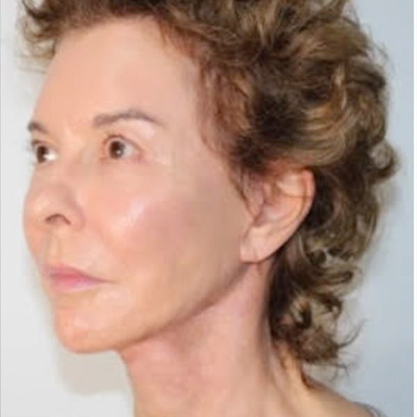 Facelift Before & After Gallery - Patient 205212 - Image 2