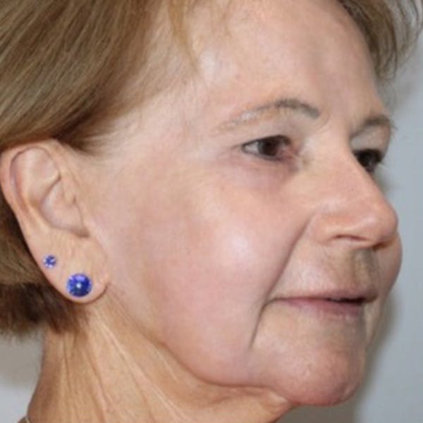 Croton Oil Peel Before & After Gallery - Patient 292963 - Image 2