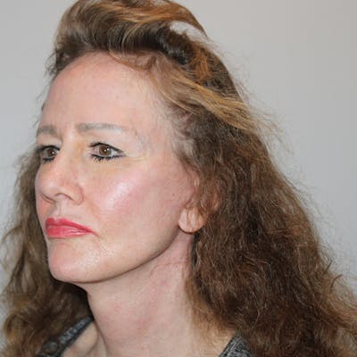 Croton Oil Peel Before & After Gallery - Patient 234376 - Image 2