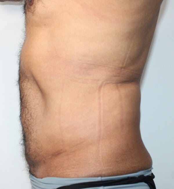 Liposuction For Men Before & After Gallery - Patient 208073 - Image 2