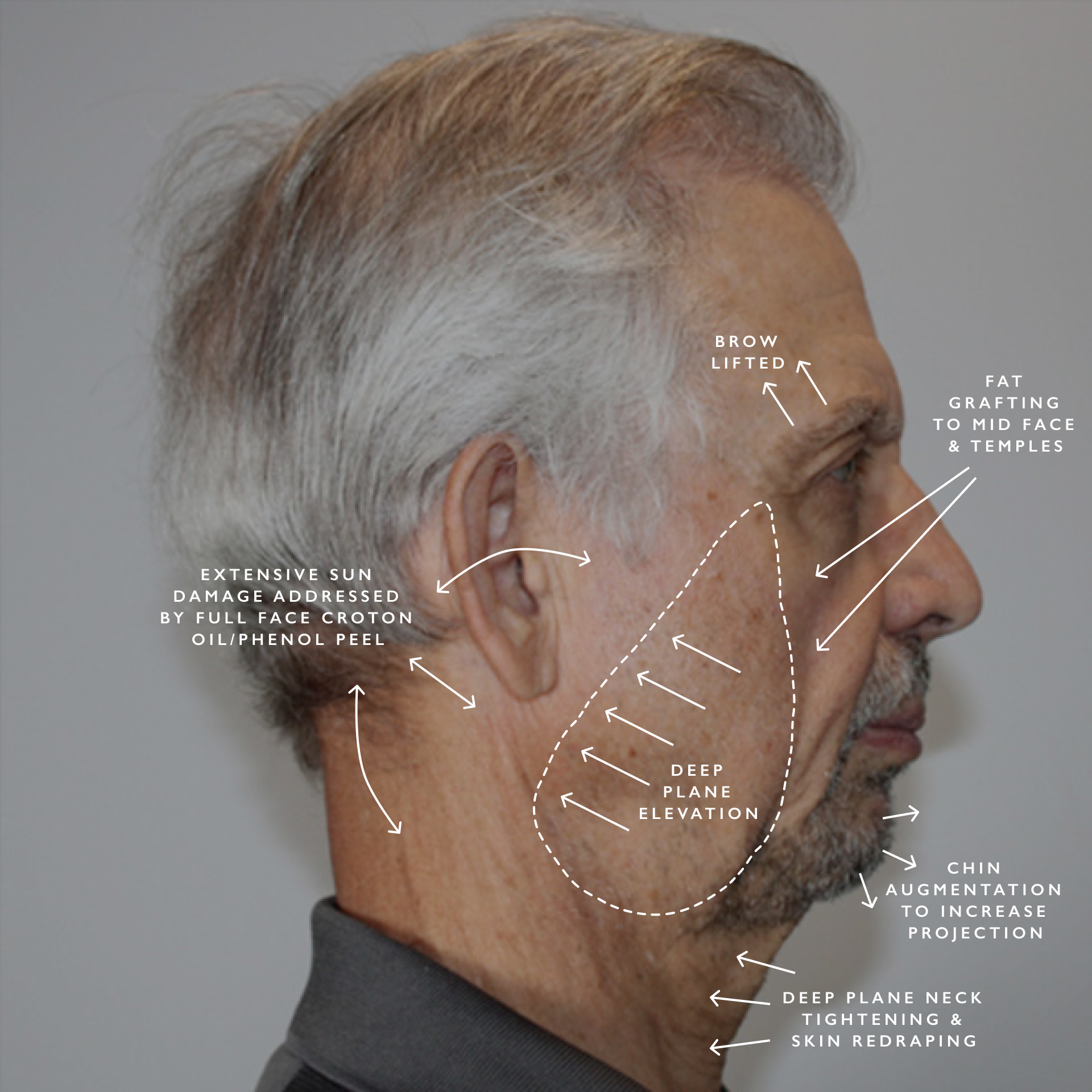 before infographic