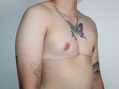 Female to Male Before & After Gallery - Patient 406813 - Image 2